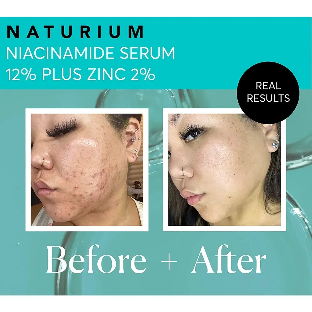 niacinamide and hyaluronic acid serum