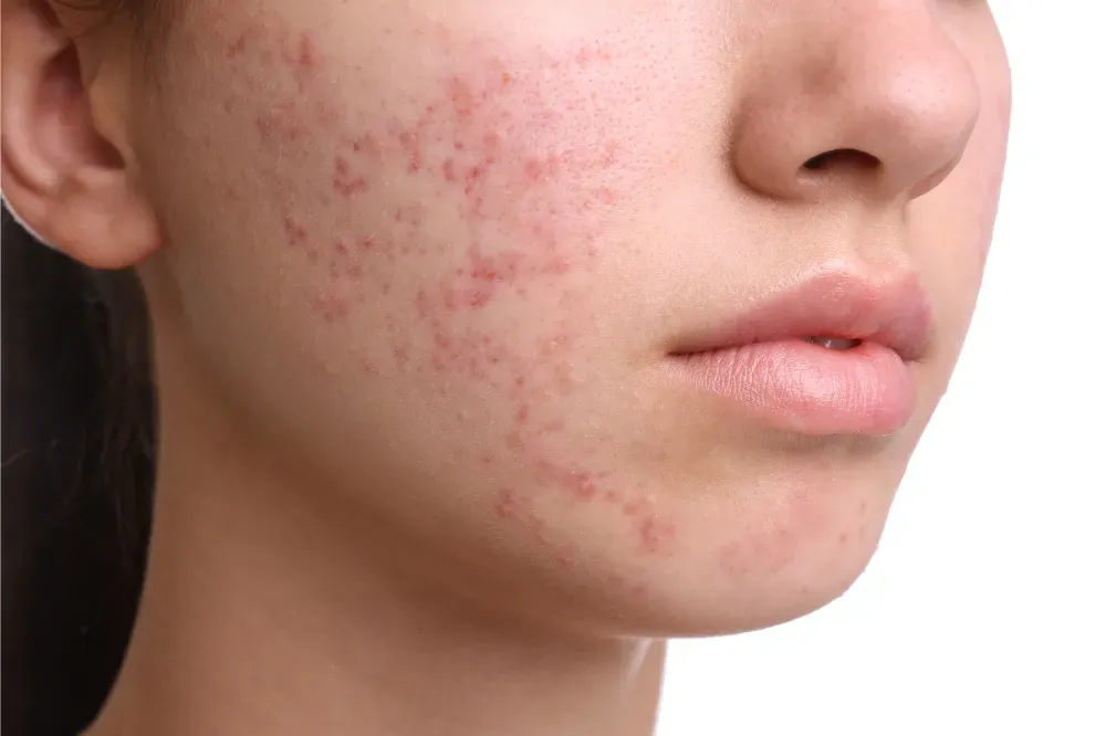Can Cica remove acne scars